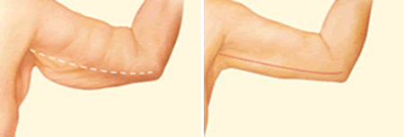Arm Lift