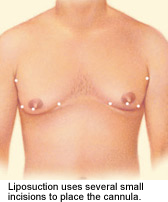 Gynecomastia Drawing