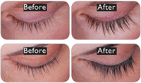 Latisse Before and After