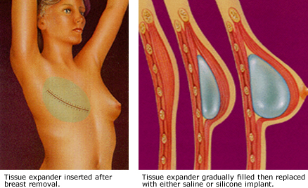 Breast Reconstruction Drawings