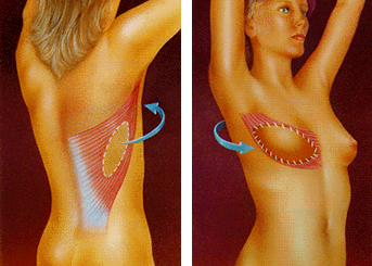Breast Reconstruction Drawing