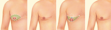 Male breast reduction images