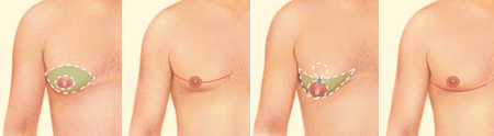 Male breast reduction images