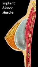 Implant Above Muscle