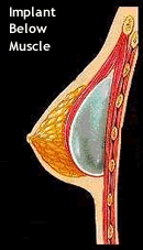 Implant Below Muscle
